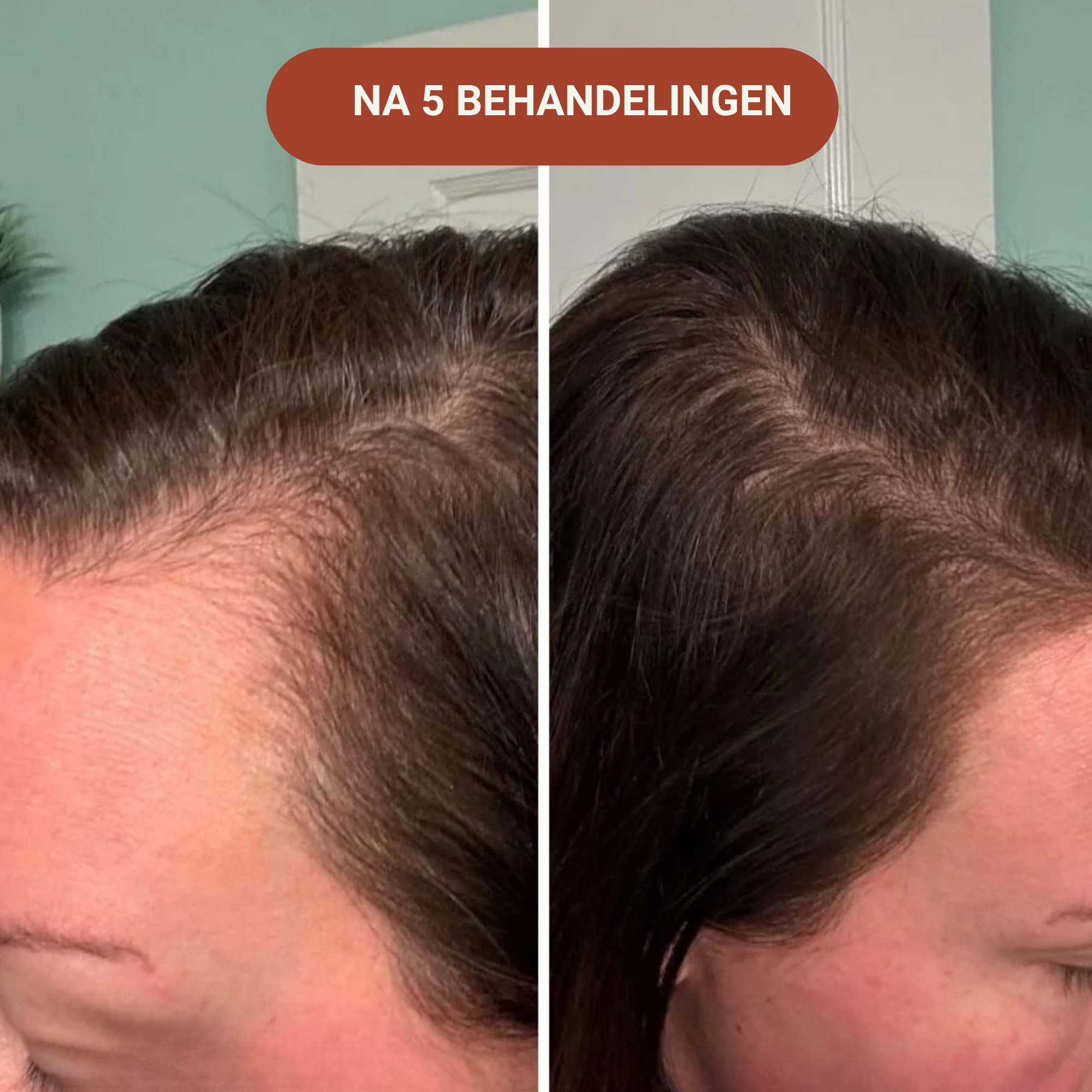 Micro-Infusie Haargroei Kit