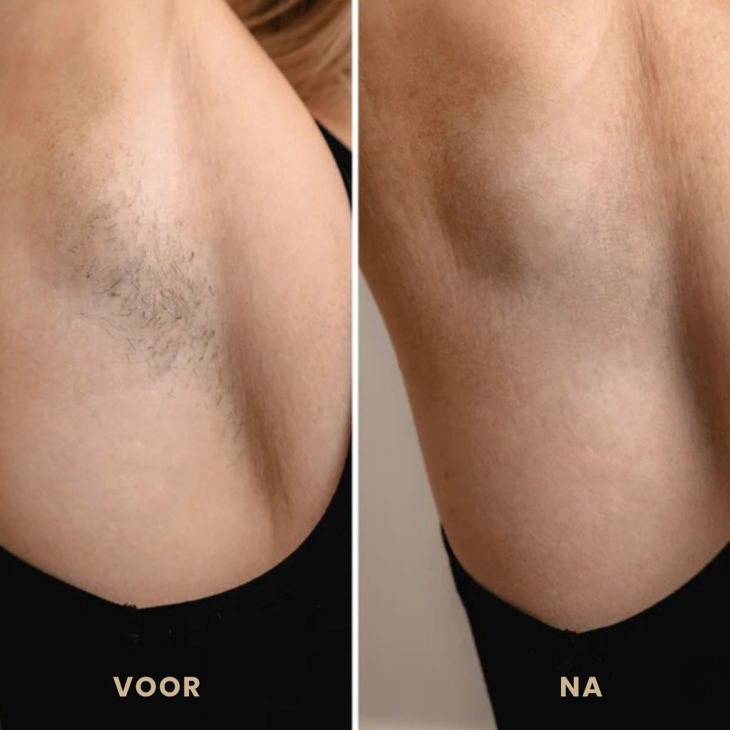 LumiSkin™ IPL Pro orvicks