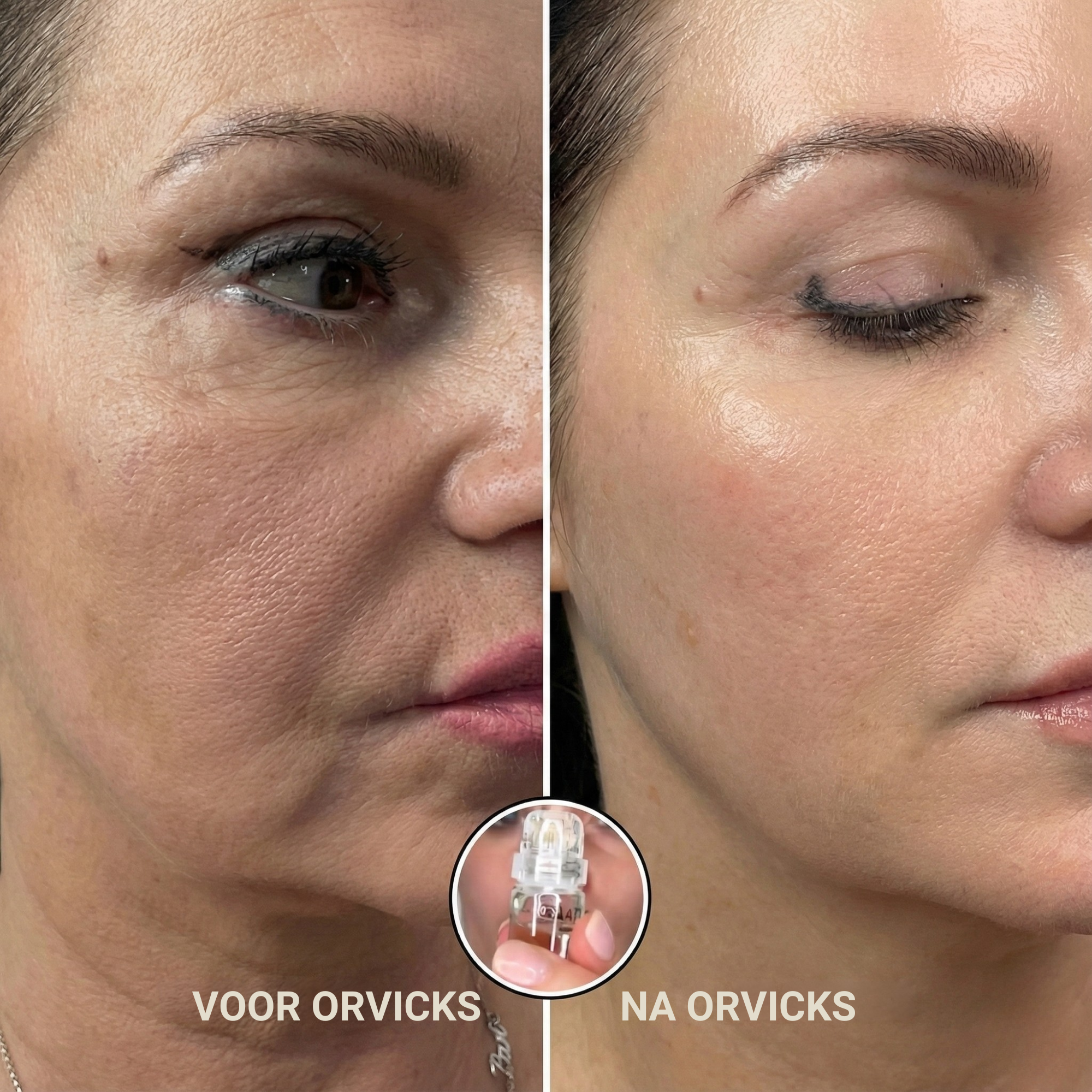 Micro-Infusie Anti-Aging Kit