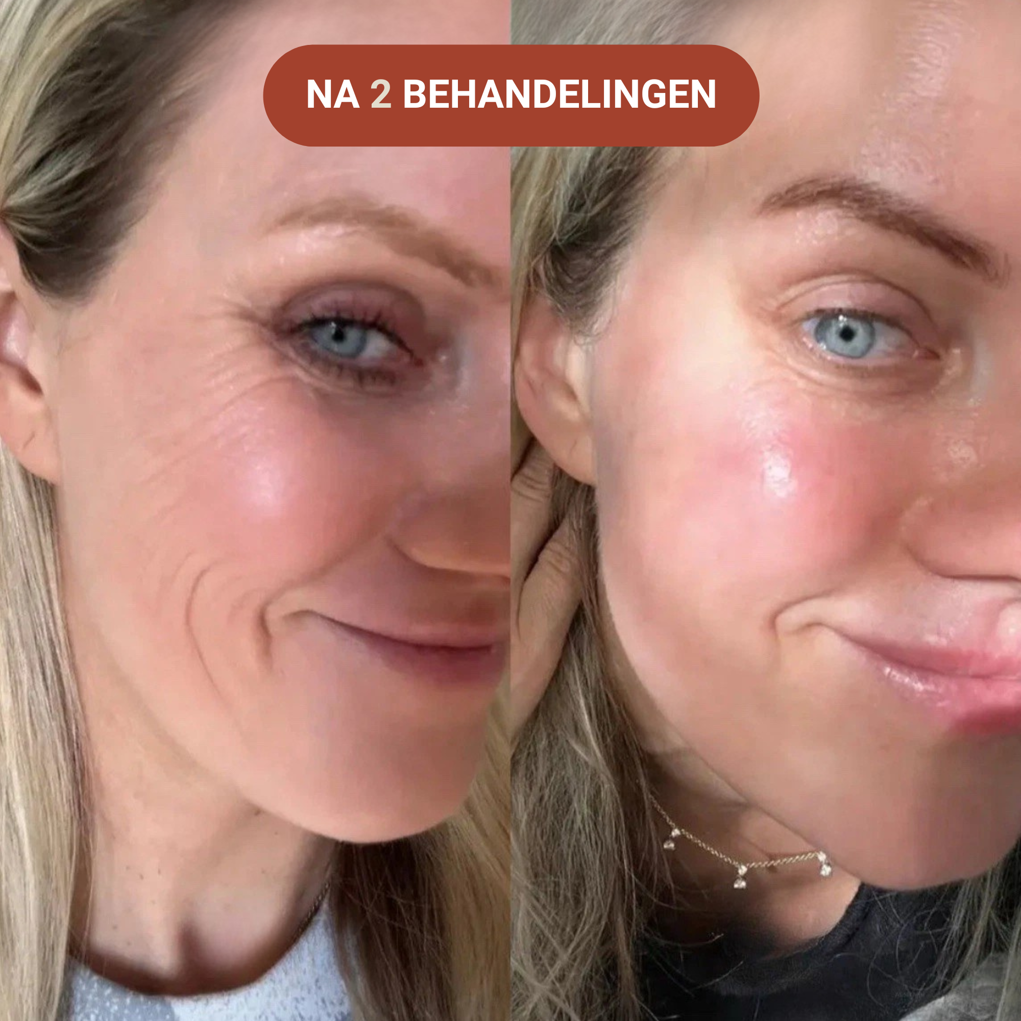 Micro-Infusie Anti-Aging Kit