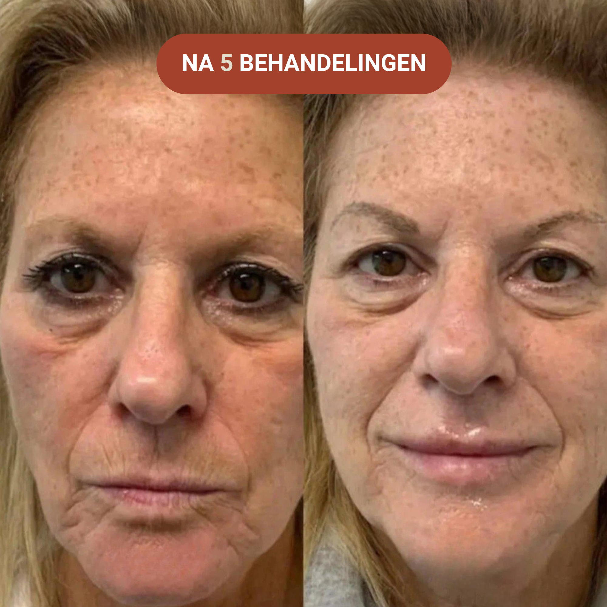 Micro-Infusie Anti-Aging Kit