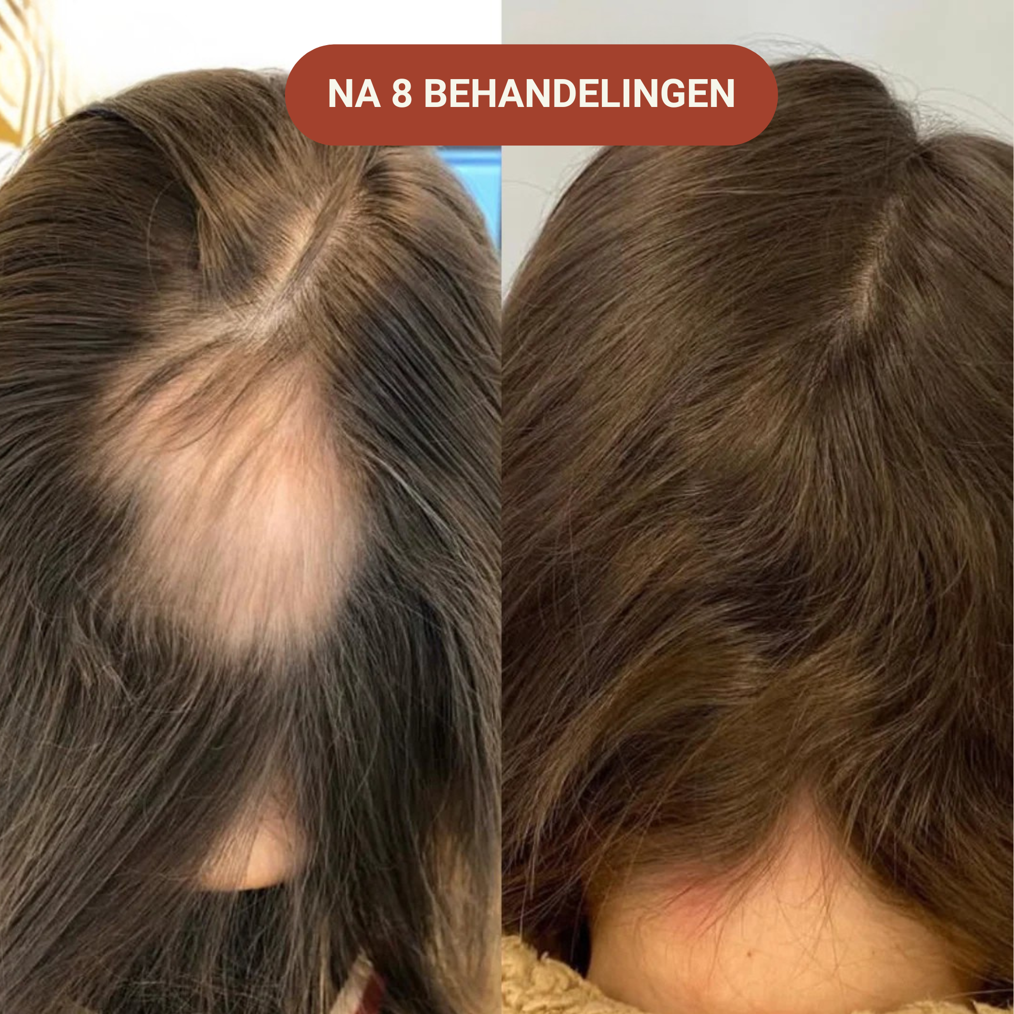 Micro-Infusie Haargroei Kit