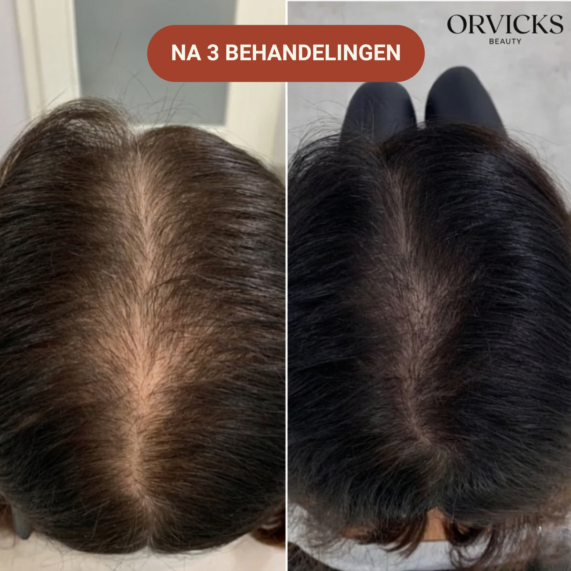 Micro-Infusie Haargroei Kit